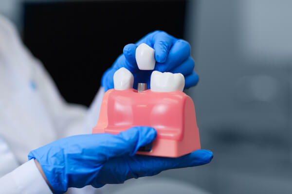 Är tandimplantat en lösning för barn?
